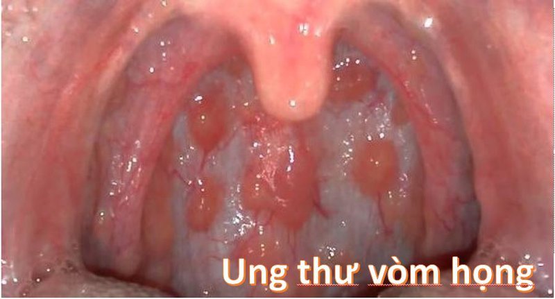 K Vòm Họng Nên Uống Sữa Gì?